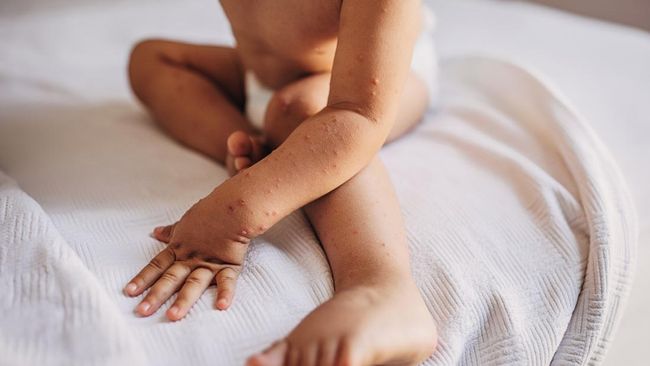 Indonesia Darurat Campak: Meningkat Sampai 32 Kali Lipat, Ini Penyebabnya