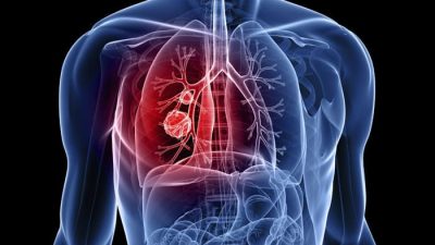 क्षयरोग पहिचानमा ढिलाइ हुँदा दोलखामा तीन जनाको मृत्यु