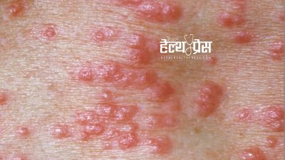 लुतो उपचारमा पर्मेथ्रिन क्रीम कि आइभरमेक्टिन ? अन्तर्राष्ट्रिय अनुसन्धान