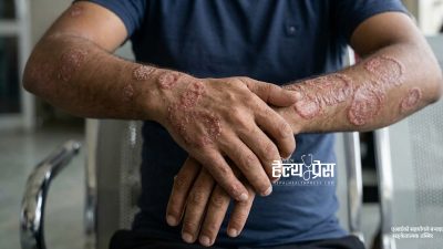 बल्झिरहने छालाको संक्रमण(दाद)को उपचार अब मलमले मात्र पुग्दैन, मानसिक परामर्श&hellip;