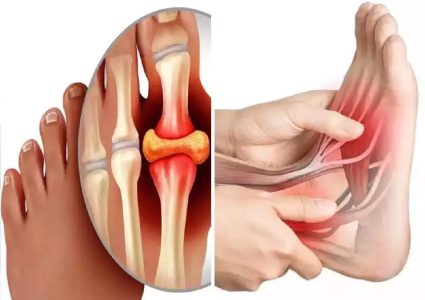 यूरिक एसिड बढ्दा के खाने के नखाने